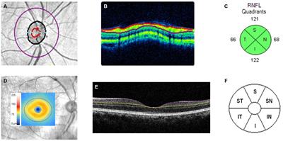 Cardiovascular disease and thinning of retinal nerve fiber layer in a multi-ethnic Asian population: the Singapore epidemiology of eye diseases study